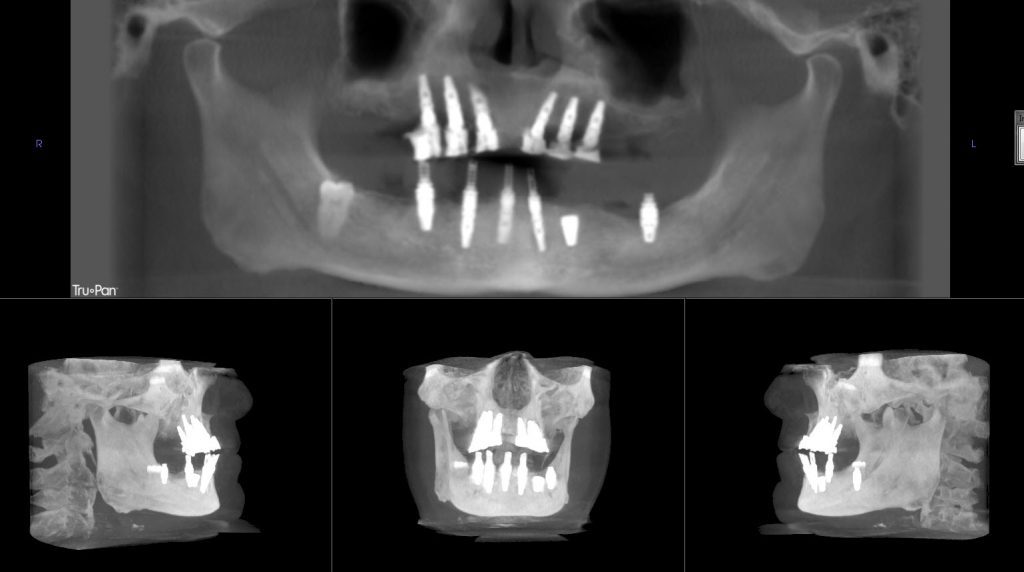 Sam's after 3D imaging showing all 12 dental implants