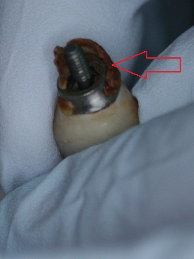 cement sepsis on abutment