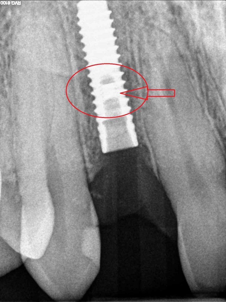 dental implant problems