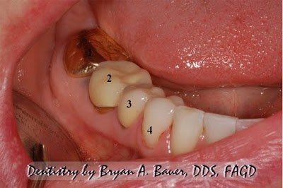 dental crowns on molars