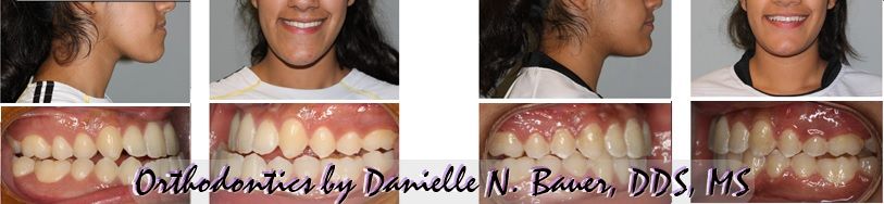 orthodontics surgical before and after Danielle