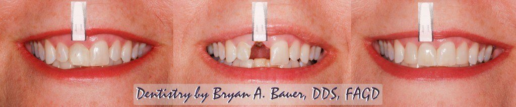 before and after dental implant