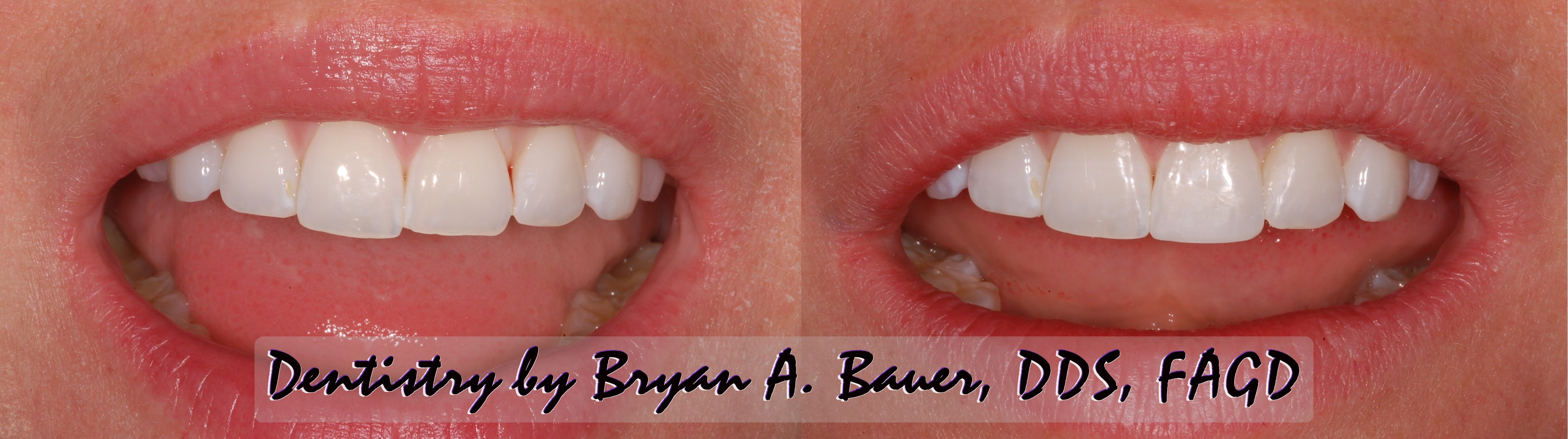 Chipped front tooth filling - Easy Solution! - Bauer Smiles