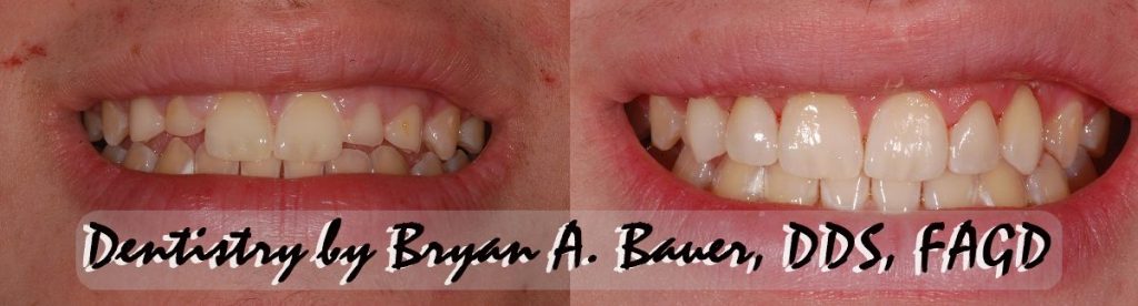 Veneers for baby teeth are a great way to fix a smile quickly