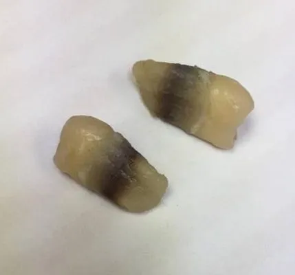 black staining on extracted teeth